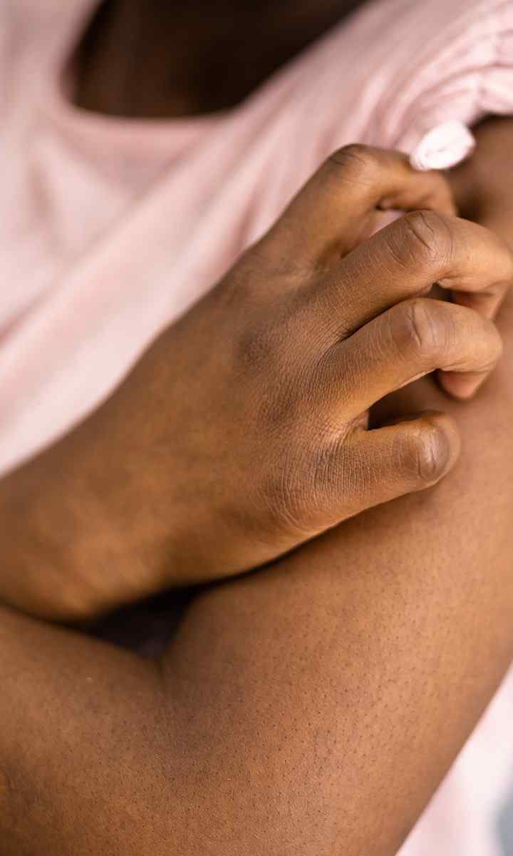 How Should You Treat Seborrheic Dermatitis How Should You Treat Seborrheic Dermatitis